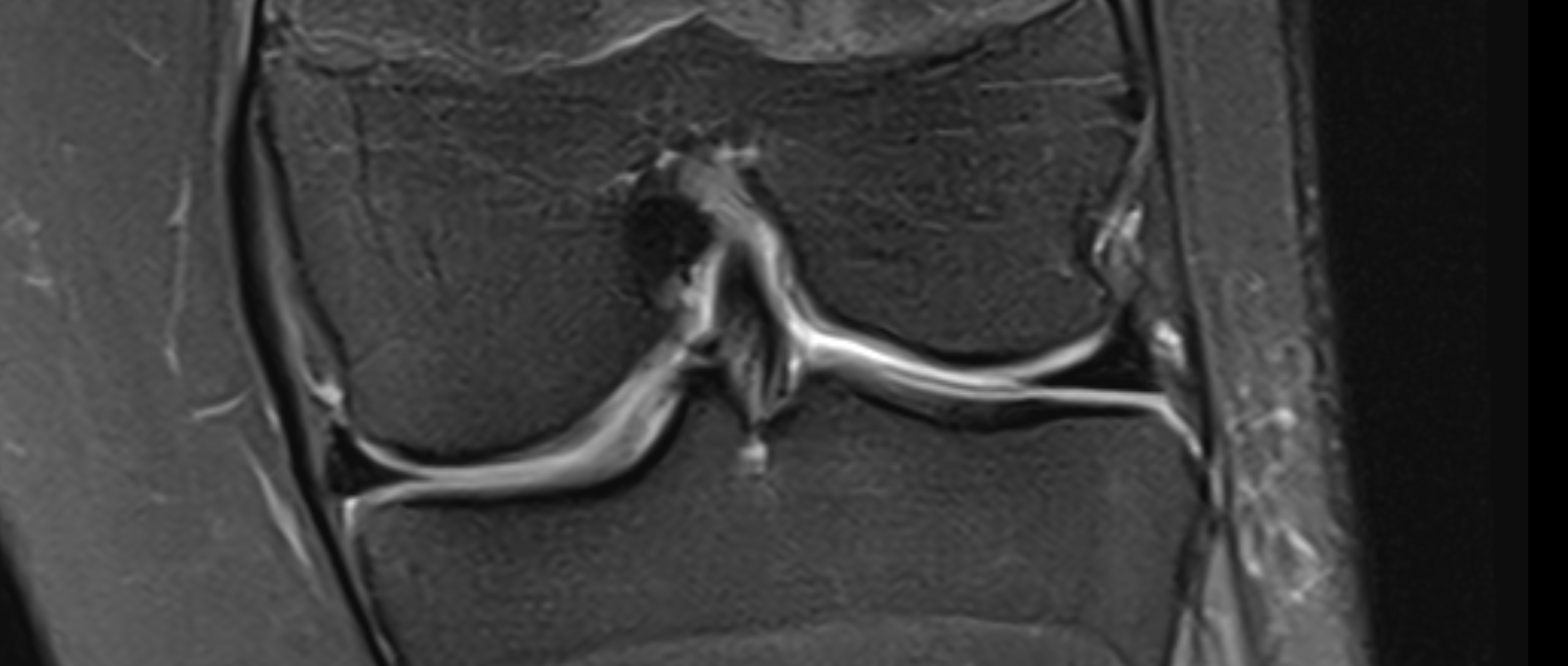 Fragment in Notch Sign